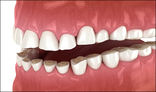 Bruxism