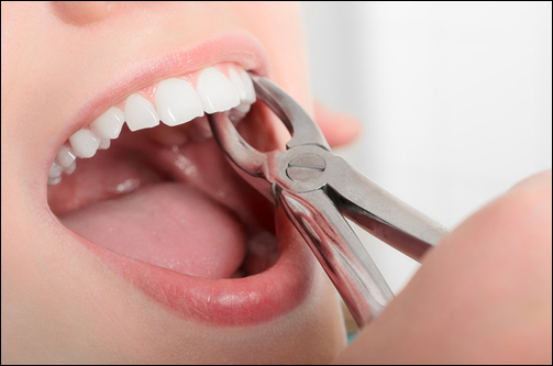 Tooth Extraction